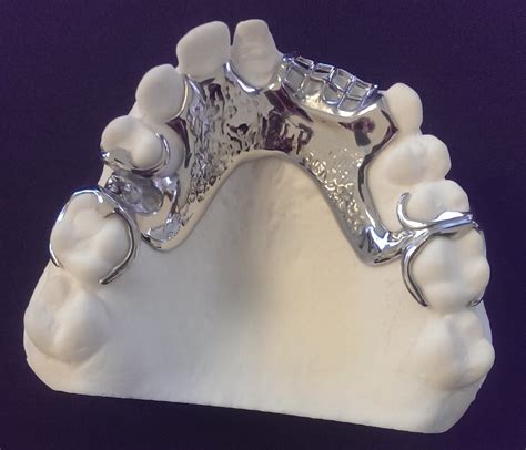 Removable Partial Denture With Metal Framework