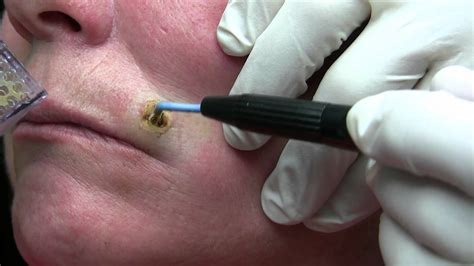 removal of a mole procedure