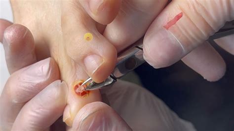 Removal Of Corn Between Toes