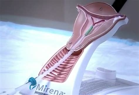 removal of iud mirena