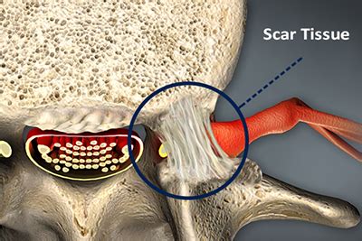 Removal Of Scar Tissue