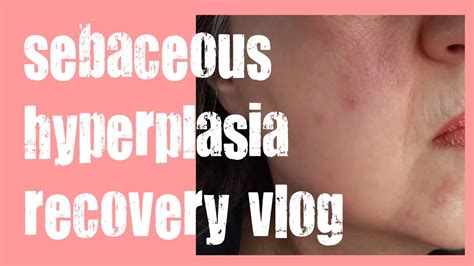 removal of sebaceous hyperplasia