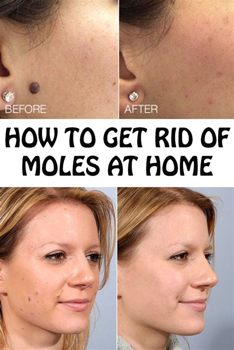 Say Goodbye to Unwanted Moles: A Safe and Effective Guide to Remove Moles at Home Naturally