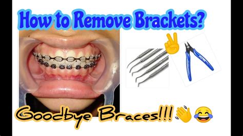Remove My Braces At Home