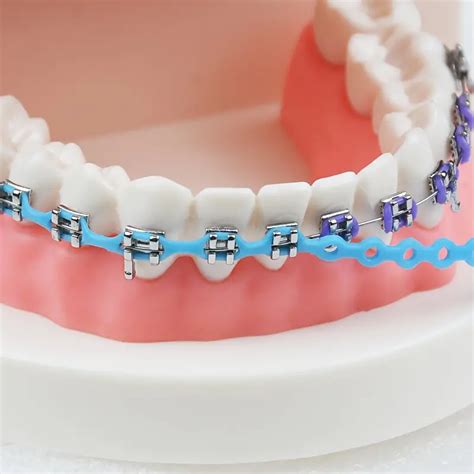 Remove Power Chain From Braces