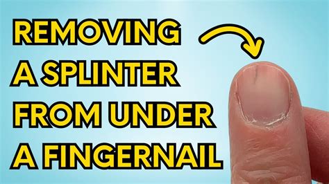 Remove Splinter Under Fingernail Baking Soda