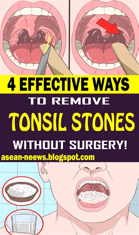 remove tonsil stones naturally