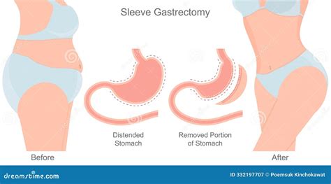 Removed From The Body