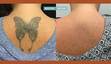 Removery Tattoo Removal And Fading Edmonton Results Of Laser