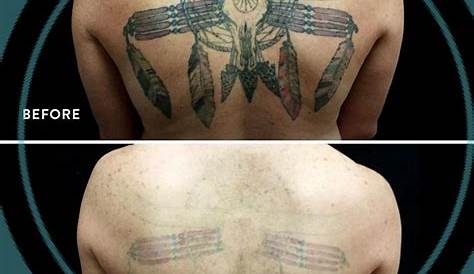 Removery Tattoo Removal Fading Edmonton Reviews Full
