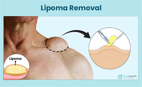 Safe and Effective Methods for Removing a Lipoma