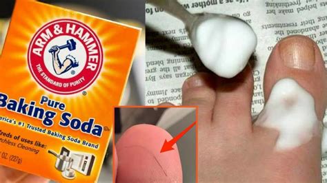 How To Remove a Splinter With Baking Soda Happy Life YouTube