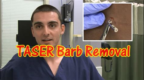 Removing A Taser Barb
