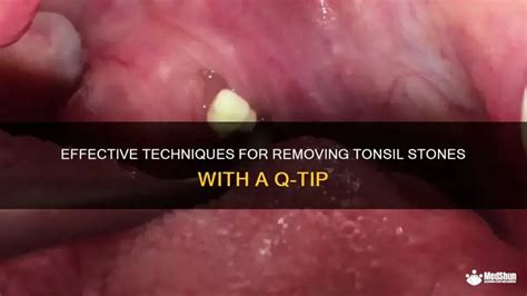 Tonsil Stone Relief: A Step-by-Step Guide to Removing Stones from Tonsils Safely