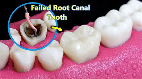 removing tooth after failed root canal