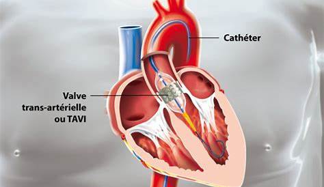 Remplacement valvulaire aortique avec ou sans