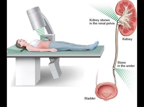 Renal Endoscopy Cpt Code