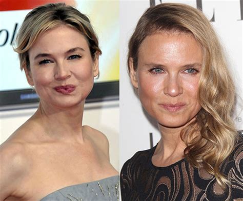 renee zellweger before and after surgery