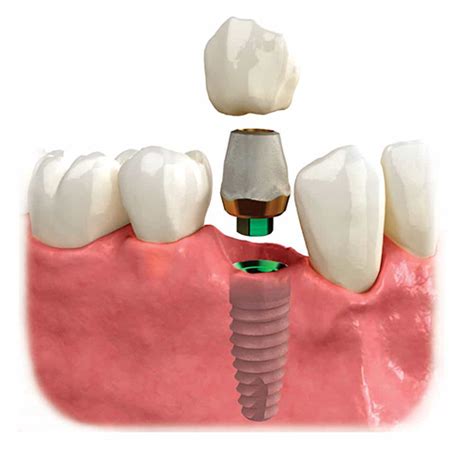reno implants and dentures
