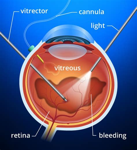replace vitreous fluid in eyes