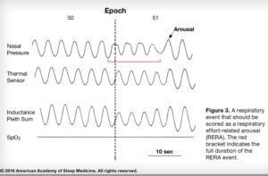rera index sleep apnea