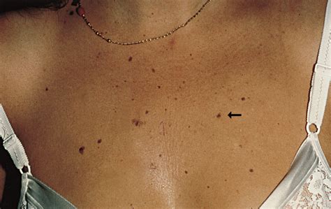 residual malignant melanoma in situ