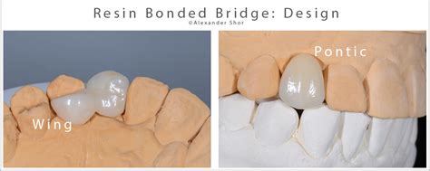 resin bonded bridge design