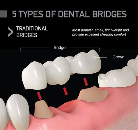 resin vs porcelain bridge