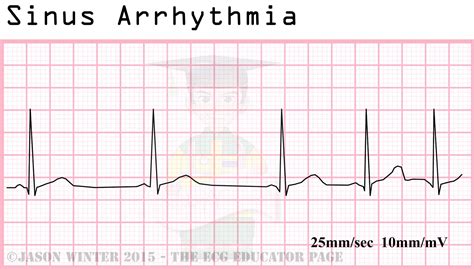 respiratory sinus arrhythmia ecg