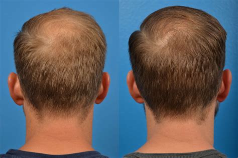 Hair Restoration Laboratories Hair Restore Professional Strength