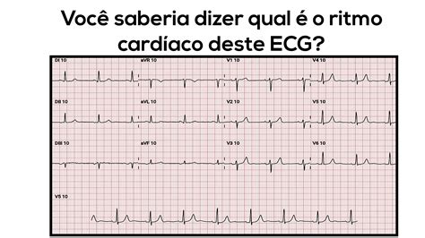 resultado eletrocardiograma ritmo sinusal