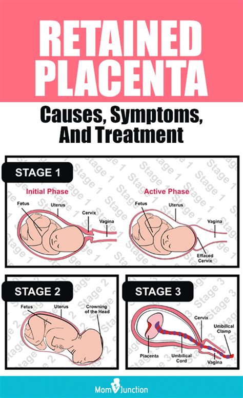 Retained Placenta Symptoms: What You Need to Know Immediately