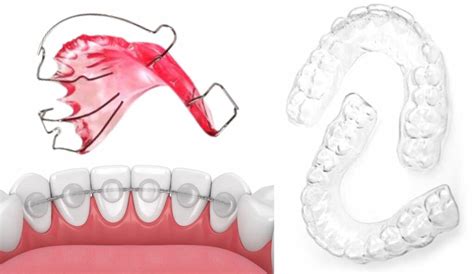 Retainer For Bottom Teeth Cost