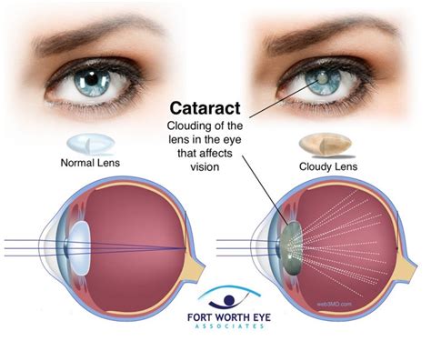 retinal detachment following cataract surgery
