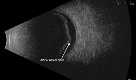 retinal detachment ocular ultrasound