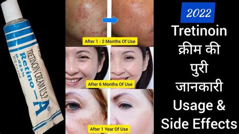 retinol cream benefits in hindi