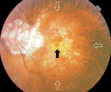 Retinoschisis Myopia