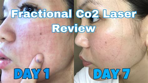 Review Laser Co2