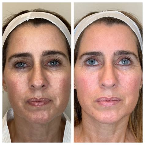 Patient 8693710 Evoke Radiofrequency Before & After Photos Austin Face & Body
