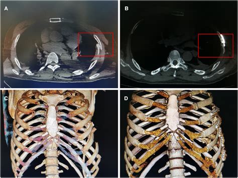 Rib Fracture Ct Scan
