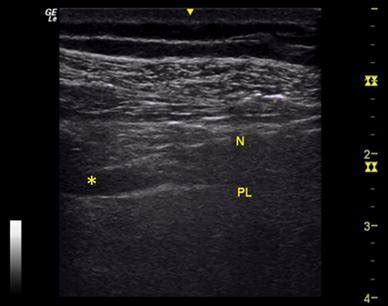 Rib Fracture Intercostal Block