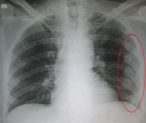 Rib Fracture Wikipedia