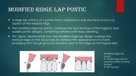 ridge lap pontic