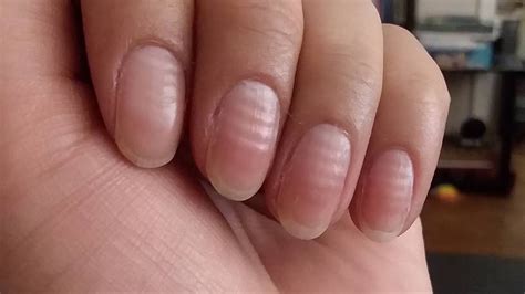 Ridges In Hand Nails