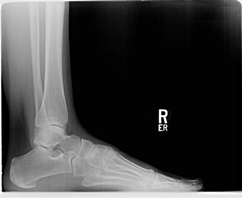 right ankle x ray