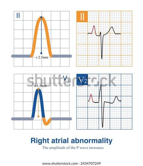 Right atrial enlargement is defined as either P >2.5 mm in II / III and