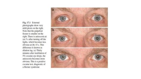 right eye vision problems icd 10
