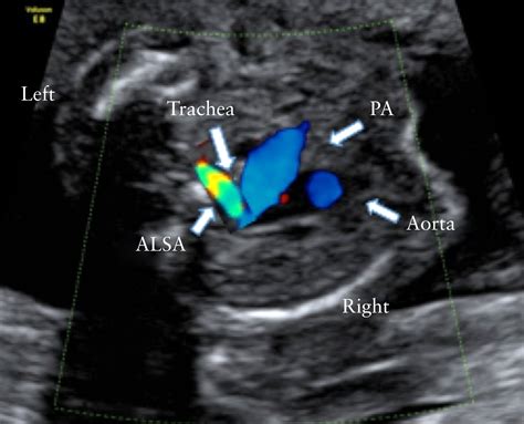 right sided aortic arch fetal ultrasound