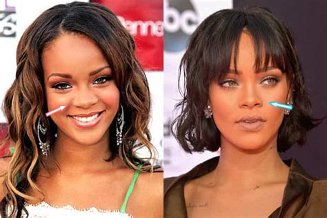 rihanna before and after surgery