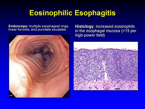 ringed esophagus eosinophilic esophagitis